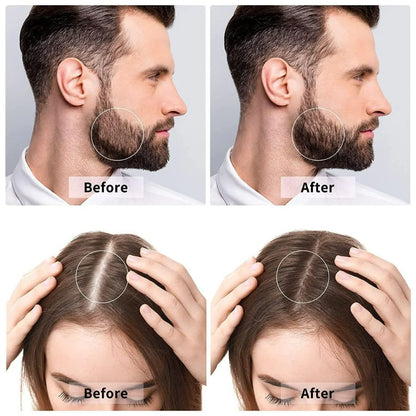 Derma Roller For Hair & Beard Growth 0.5 mm