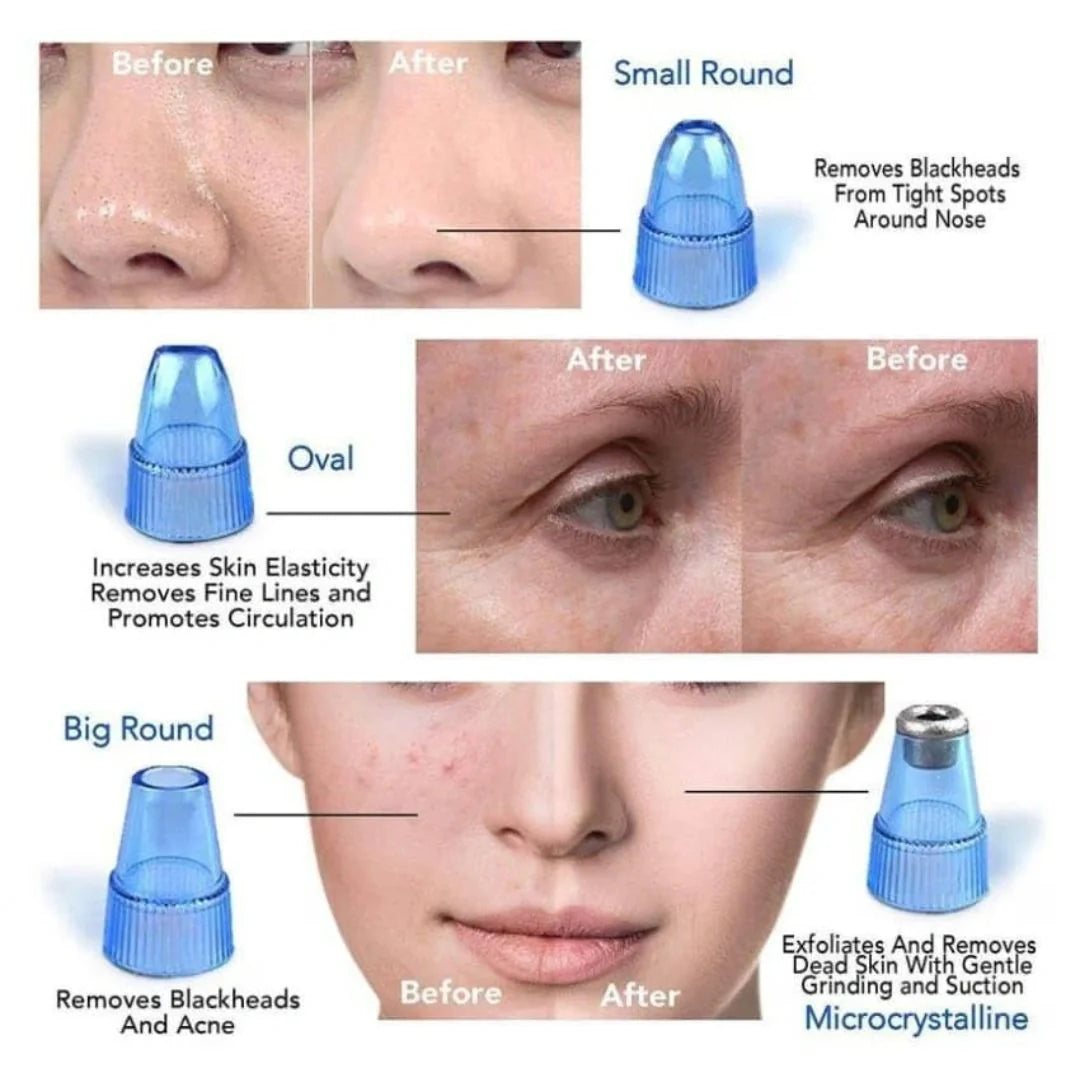 Blackhead Remover Vacuum Device with Suction Heads